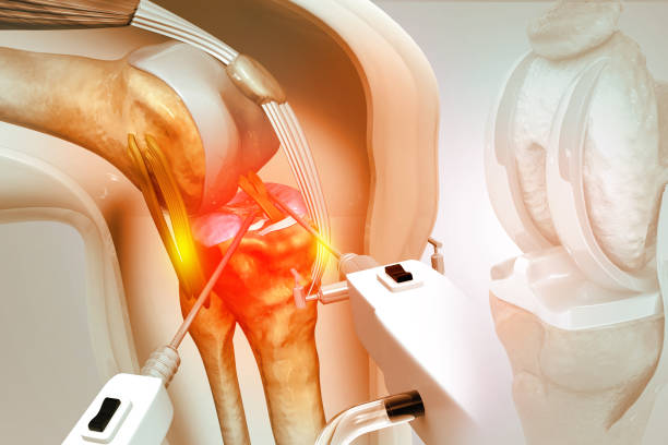 Joint Replacement Surgery